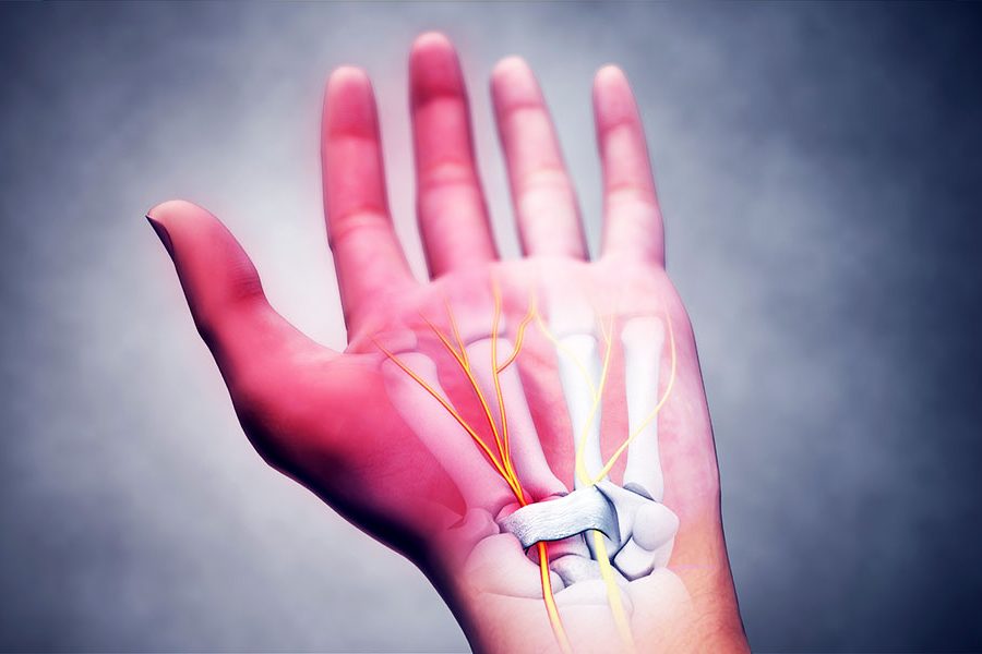 σύνδρομο καρπιαίου σωλήνα 1